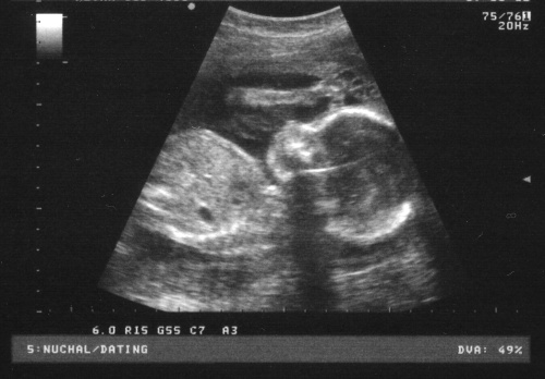 sonogram-human-foetal-fetal-ultrasound-scan-at-22-weeks-mono-1-ANON